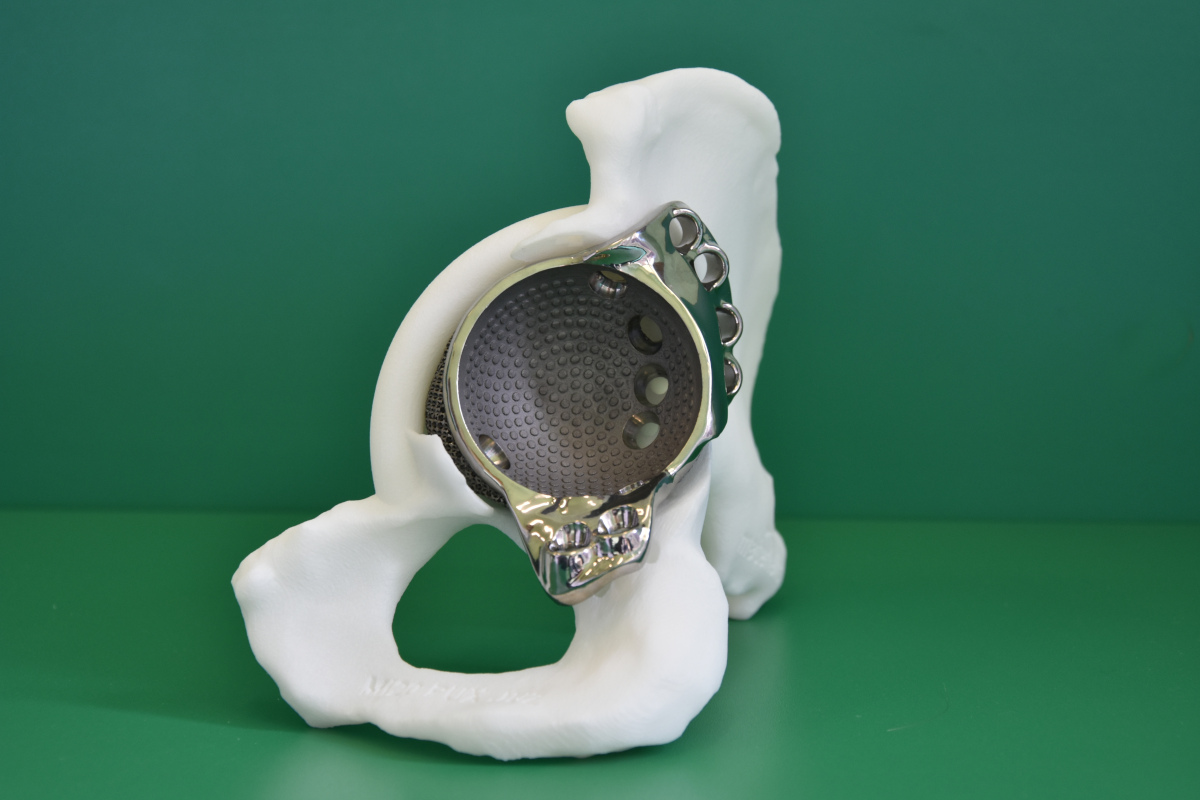 implant stawu biodrowego
