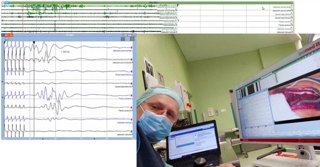 3-ver-nowe Neuromonitoring w czasie rzeczywistym oraz inne innowacje neuromonitoringu śródoperacyjnego podczas operacji na kręgosłupie